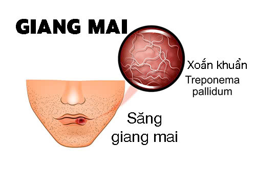 Nữ giới bị giang mai có quan hệ được không?